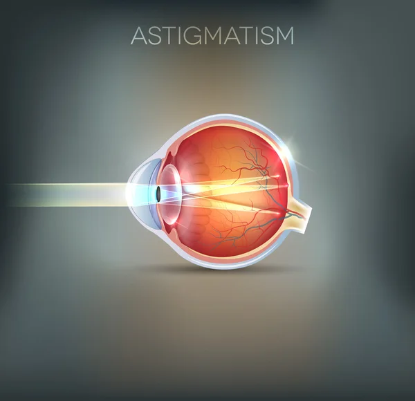 Astigmatism, vision disorder — Stock Vector