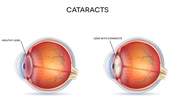 Cataractes — Image vectorielle