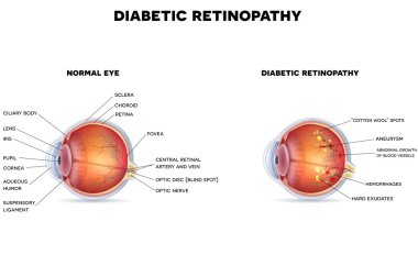 Diabetic retinopathy and healthy eye clipart
