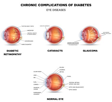 Diabetic Eye Diseases clipart