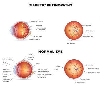 Diyabetik retinopati ve normal göz