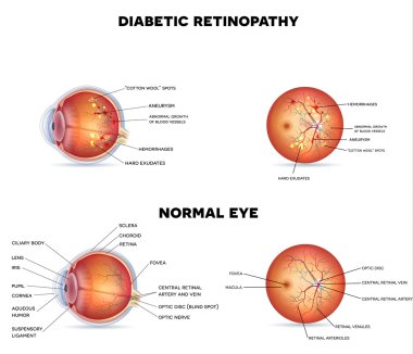 Diabetic retinopathy and normal eye clipart