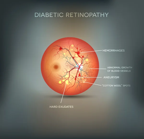 Retinopatía diabética antecedentes — Archivo Imágenes Vectoriales