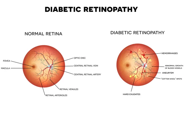 Diabetic retinopathy detailed illustration — Stock vektor