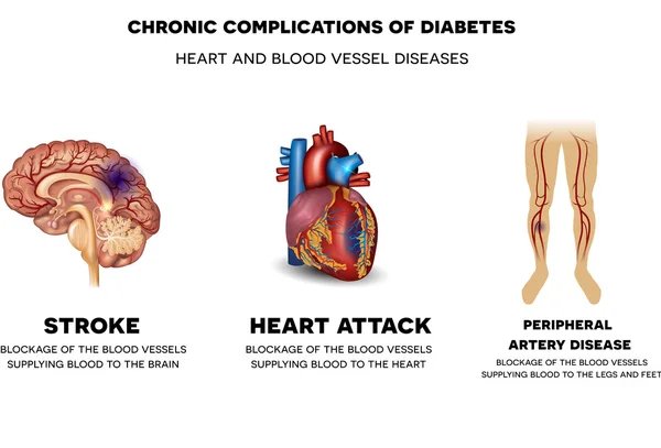 Chronische complicaties van Diabetes. Hart en bloedvaten diseas Vectorbeelden