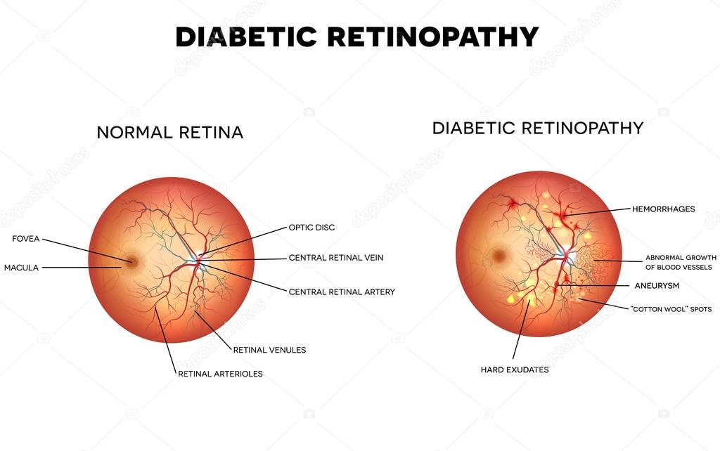 Diabetic retinopathy detailed illustration — Stock Vector © megija