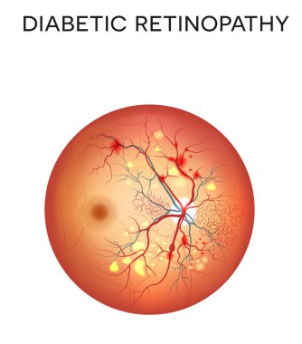 Diyabetik retinopati göz hastalığı
