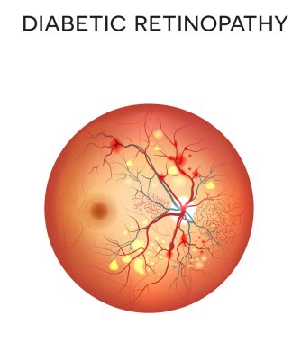 Diabetic retinopathy eye disease clipart