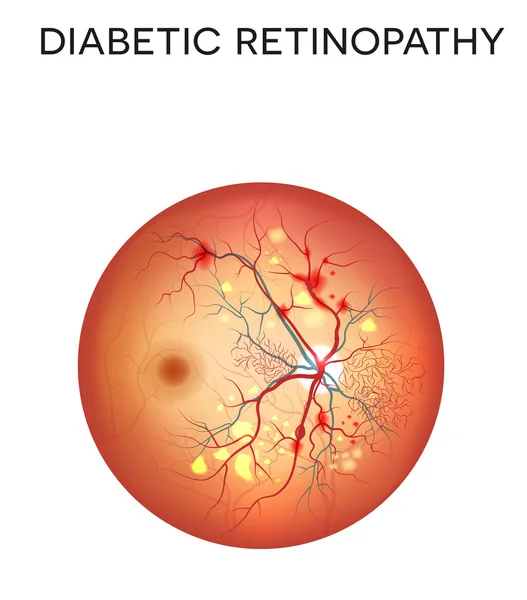 Retinopatía diabética enfermedad ocular — Archivo Imágenes Vectoriales