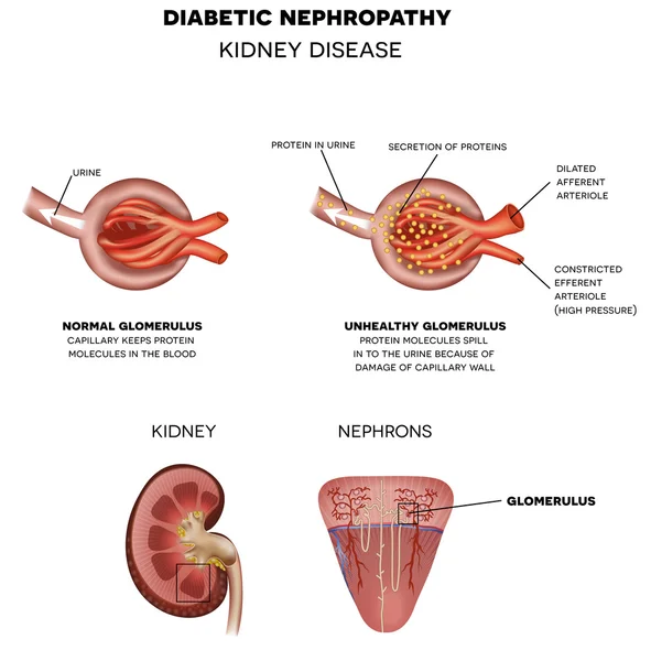 Diabetic Nephropathy, kidney disease — Stock Vector