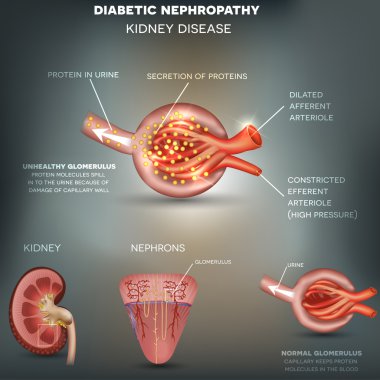 Diyabetik nefropati, böbrek hastalığı