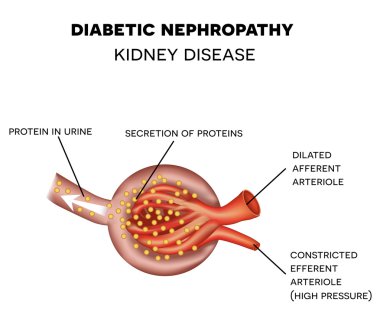 Diabetic Nephropathy, glomerulus anatomy clipart