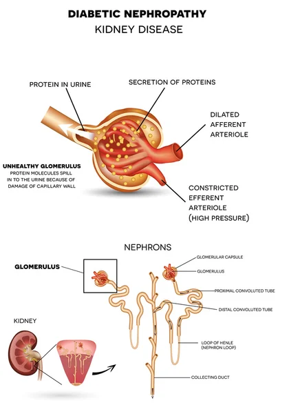 Nefropatia diabética, doença renal —  Vetores de Stock