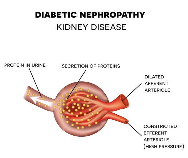 Diabetisk nefropati, glomeruli anatomi — Stock vektor