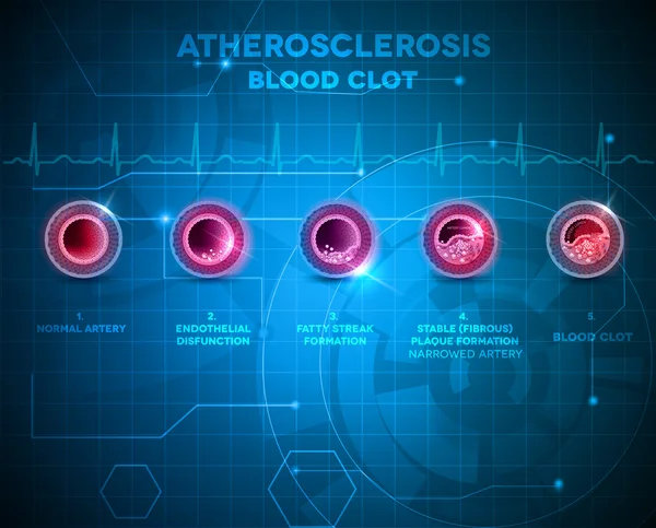 Arterienanatomie und Arteriosklerose auf abstraktem Hintergrund — Stockvektor