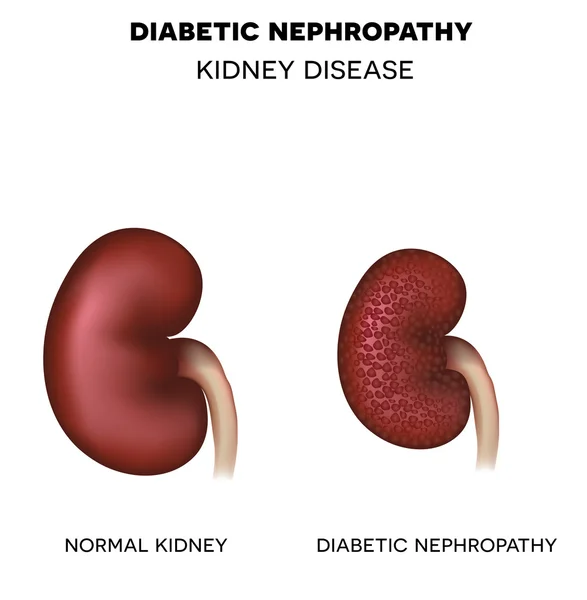 Diabetic Nephropathy, kidney disease — Stock Vector