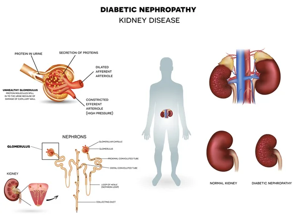 Nefropatía diabética, enfermedad renal — Vector de stock