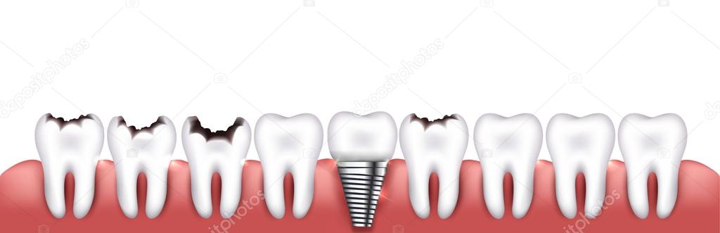 Various teeth conditions