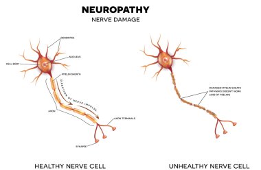 Neuropathy, nerve damage clipart