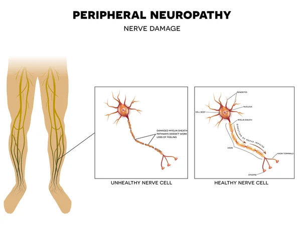 Neuropathie, schade aan de zenuwen — Stockvector