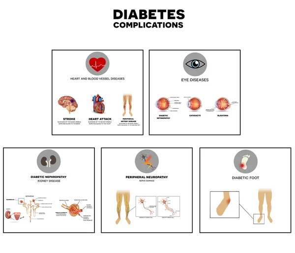 Diabetes complicaciones info gráfico — Vector de stock