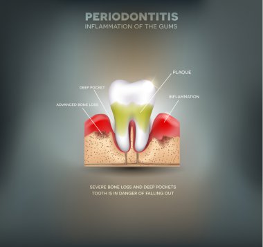 Periodontitis inflammation of the gums clipart