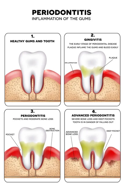 Periodontitis inflamación de las encías — Archivo Imágenes Vectoriales