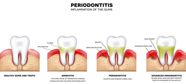 歯茎の歯周炎の炎症 — ストックベクタ