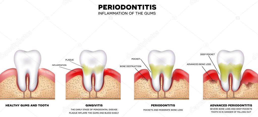 Periodontitis inflammation of the gums