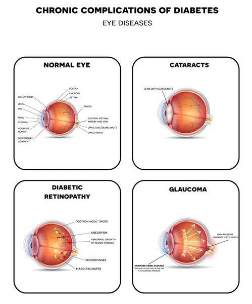 Diabetické očních chorob diagramu — Stockový vektor