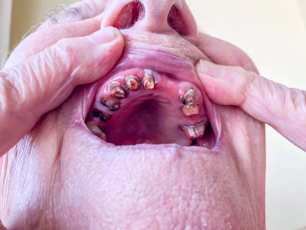 Gura Închisă Unei Bătrâne Dinți Foarte Răi — Fotografie, imagine de stoc