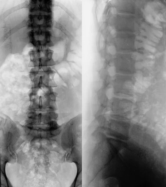 Radiografía de una columna vertebral masculina Fotos de stock