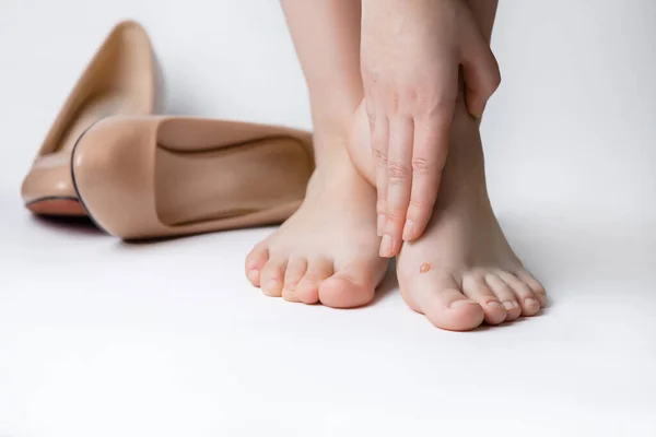 Callus blisters on woman\'s feet. Uncomfortable shoes problems.