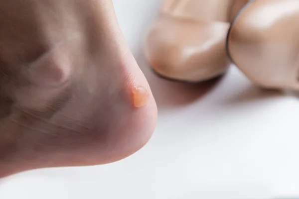 Callus blisters on woman\'s feet. Uncomfortable shoes problems.