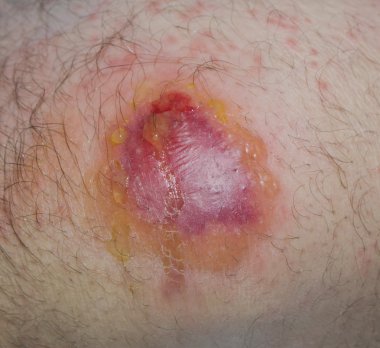 Alerjik Dermatit