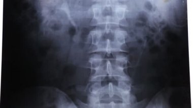X-ışınları elektromanyetik radyasyon, görünür ışık gibi bir türüdür. Bir röntgen cihazı bireysel x-ray parçacıklar vücut üzerinden gönderir.