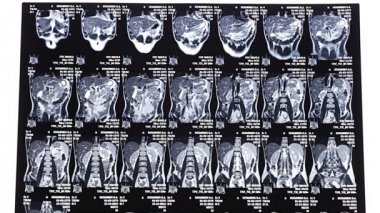 Doktorlar konuda göğüs röntgeni