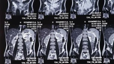 X-ışınları elektromanyetik radyasyon, görünür ışık gibi bir türüdür. Bir röntgen cihazı bireysel x-ray parçacıklar vücut üzerinden gönderir.