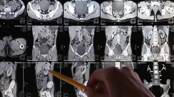 Лікарі розглядають рентген грудної клітини — стокове відео