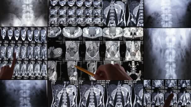Los médicos consideran radiografías de tórax, collage. Multipantalla . — Vídeos de Stock