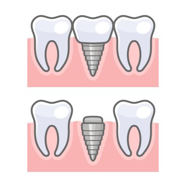 Implant diş ve Diş seti. Vektör
