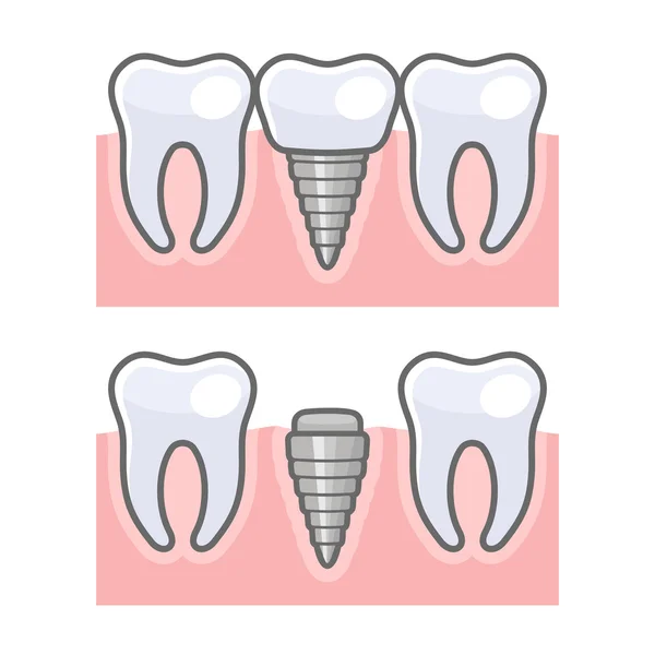 Implante dental y dentadura. Vector — Vector de stock