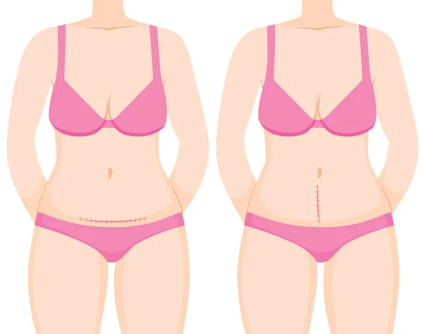 Cuerpo Mujer Mostrando Cesárea Sección Con Cicatriz Vertical Horizontal — Vector de stock