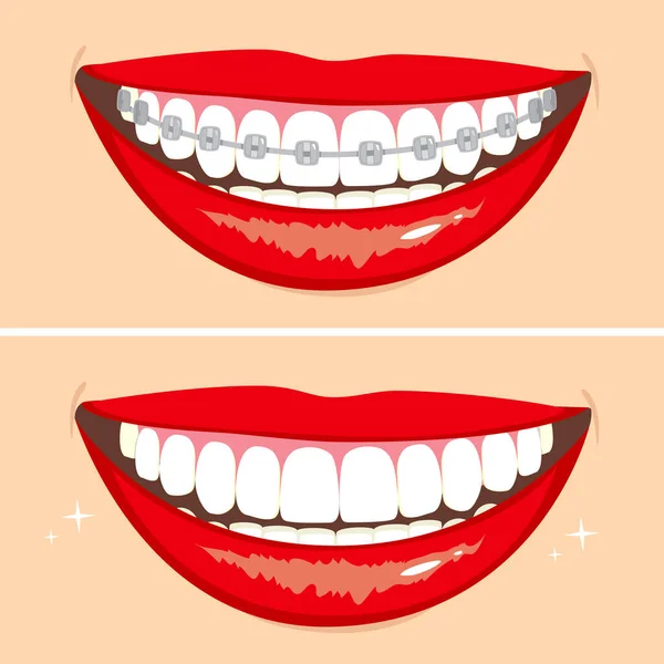 Diş Teli Takmadan Önce Sonra Iki Mutlu Gülümsemenin Görüntüsü — Stok Vektör