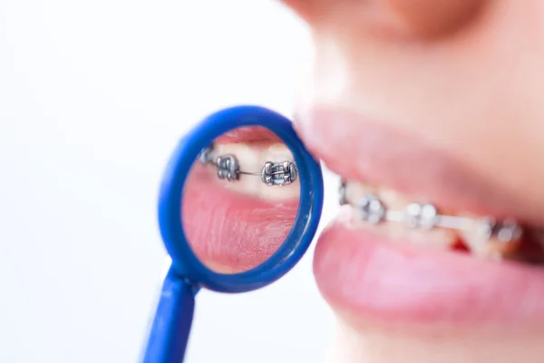 Paciente feminina mostrando o aparelho no espelho dentário — Fotografia de Stock