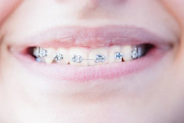 Dientes con ortodoncia . — Foto de Stock