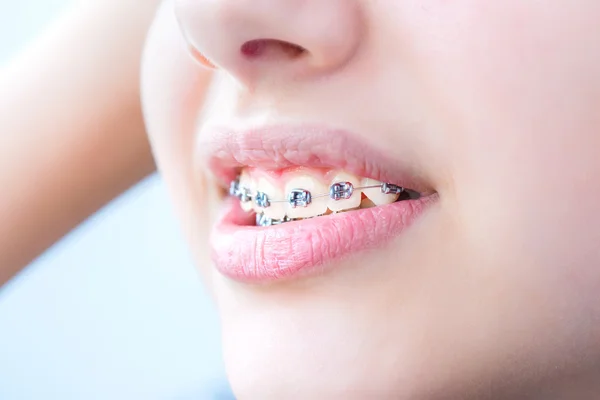 Zuby se závorkami. — Stock fotografie