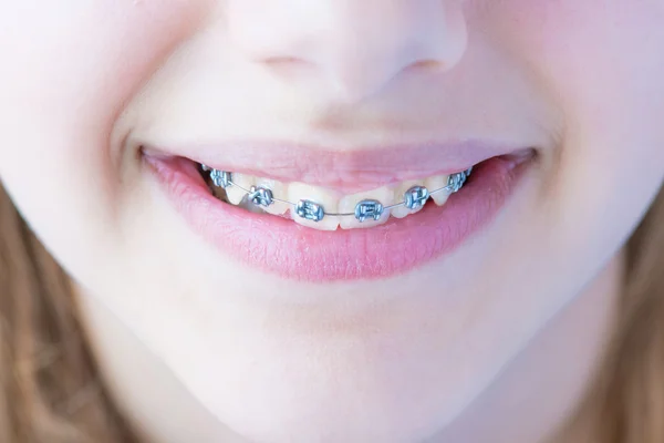 Zähne mit Zahnspange. — Stockfoto