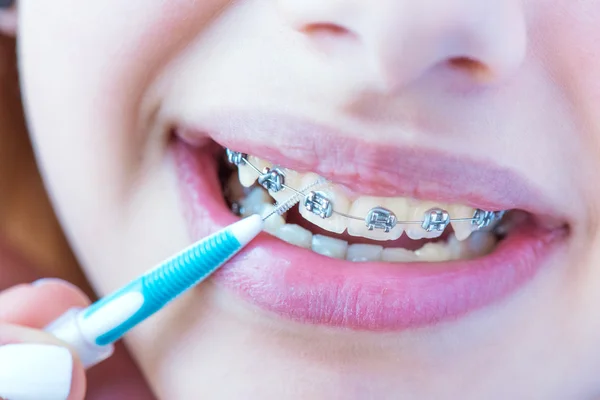 Denti femminili ravvicinati con bretelle e spazzola interdentale per l'igiene dentale . — Foto Stock