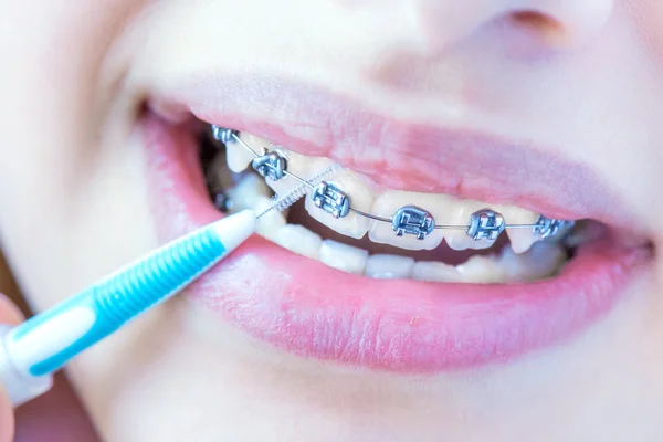 Kadın diş diş telleri ve diş diş telleri hijyen interdental fırça ile kapatmak. — Stok fotoğraf